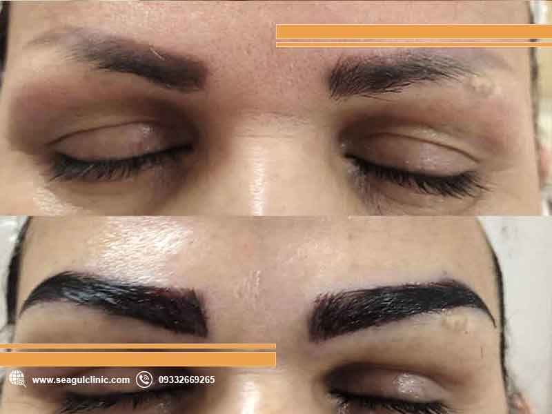 راهنمای جامع انتخاب بهترین مرکز کاشت ابرو مشهد| سی گل