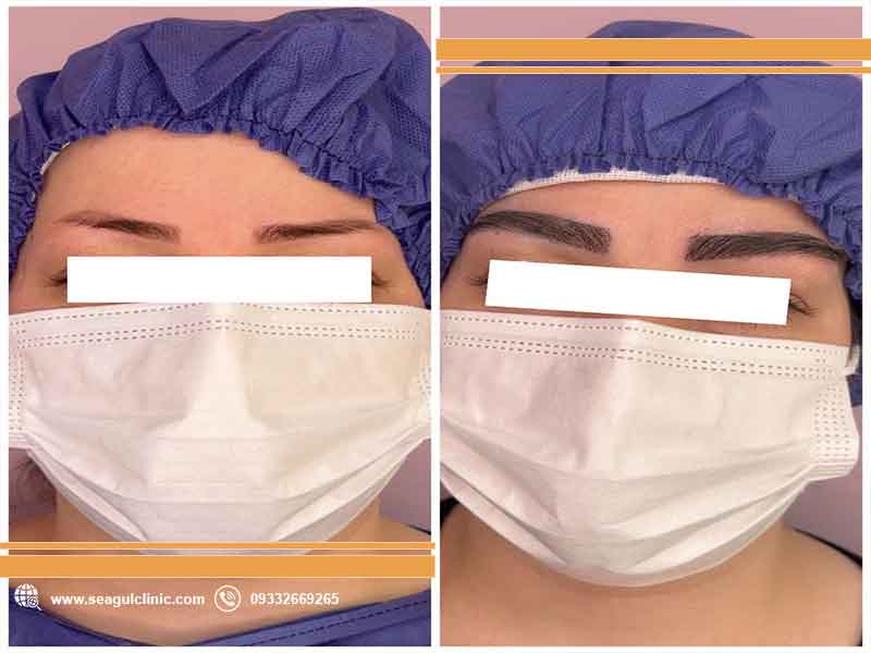راهنمای جامع انتخاب بهترین مرکز کاشت ابرو مشهد| سی گل
