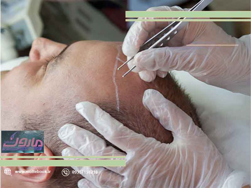 هزینه کاشت مو + 1404 | کلینیک سی گل