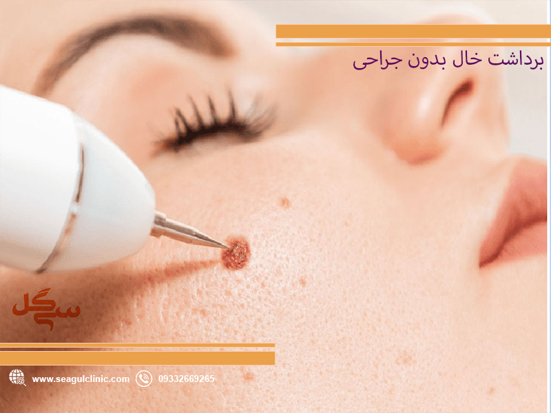 برداشت-خال-بدون-جراحی-01