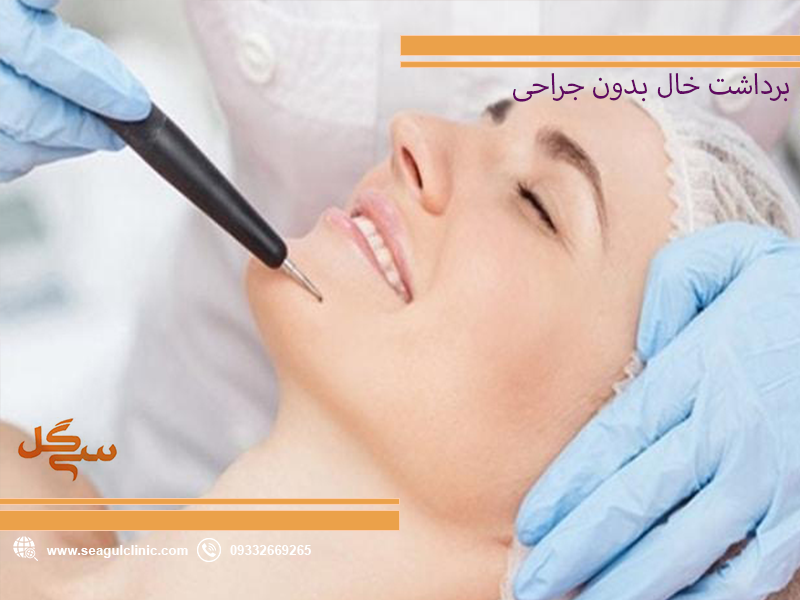 برداشت-خال-بدون-جراحی