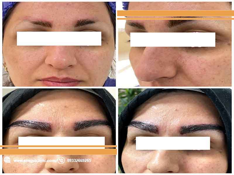 کاشت-ابرو-طبیعی--سی-گل